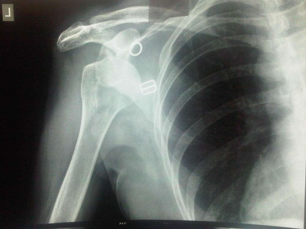 Annettes skulder uden for skålen